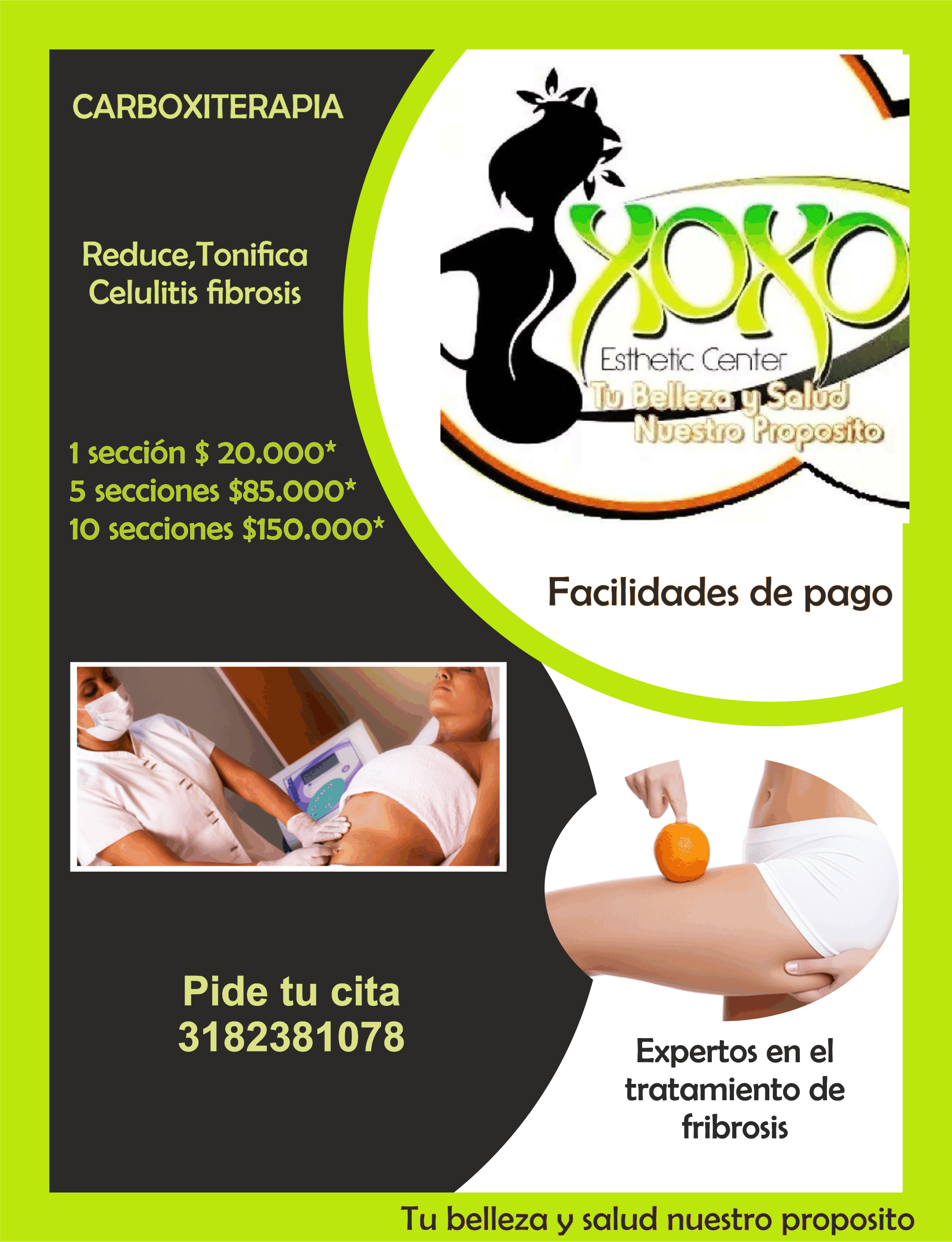 Carboxiterapia