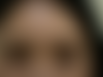 การแก้ไขชั้นตาที่โตเกิน