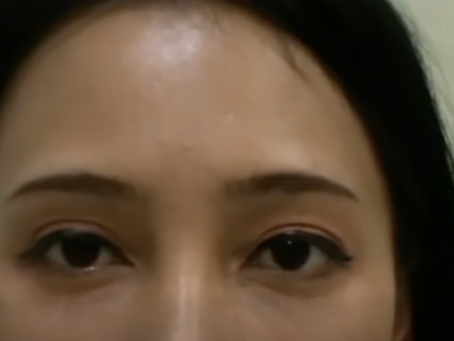 การแก้ไขชั้นตาที่โตเกิน