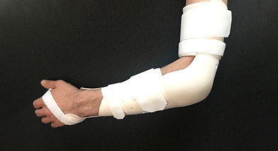 coudière fracture, immobilisation