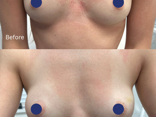 Before and after results of non-surgical breast augmentation using dermal breast filler at Harley Cosmetics London, showing increased upper-pole fullness, enhanced cleavage, and improved breast shape immediately after treatment.