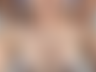 Before and after results of non-surgical breast augmentation using dermal breast filler at Harley Cosmetics London, showing increased upper-pole fullness, enhanced cleavage, and improved breast shape immediately after treatment.