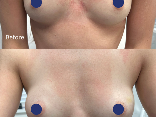 Before and after results of non-surgical breast augmentation using dermal breast filler at Harley Cosmetics London, showing increased upper-pole fullness, enhanced cleavage, and improved breast shape immediately after treatment.