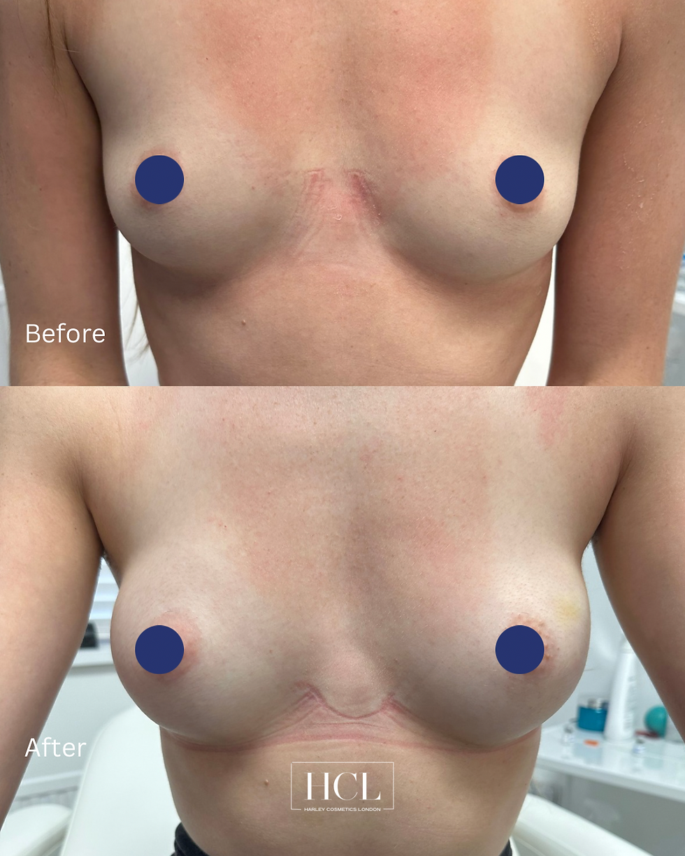 Before and after results of non-surgical breast augmentation using dermal breast filler at Harley Cosmetics London, showing increased upper-pole fullness, enhanced cleavage, and improved breast shape immediately after treatment.
