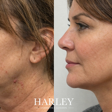 Endolift London – Before and After Results, Reviews, Cost & Is It Worth It?