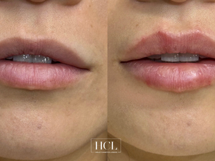 Before and after dermal lip filler showing natural lip enhancement, improved hydration, softened smoker’s lines and subtle definition