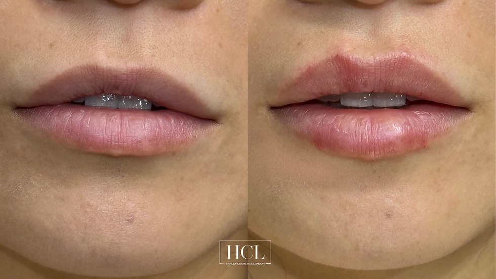 Before and after dermal lip filler showing natural lip enhancement, improved hydration, softened smoker’s lines and subtle definition