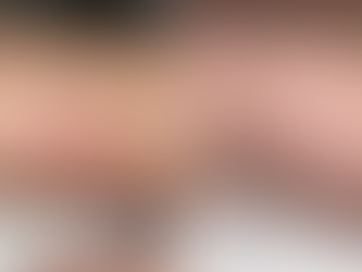 Before and after stretch mark removal at Harley Cosmetics London showing smoother texture, reduced stretch mark visibility and improved skin tone after Morpheus8 and collagen-stimulating treatments.