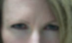 after_Dysport_treatment_glabella