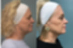 ultherapy_before_and_after2