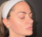 AC_Microneedling_After_photo.jpg