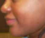 After_Cosmelan_Peel