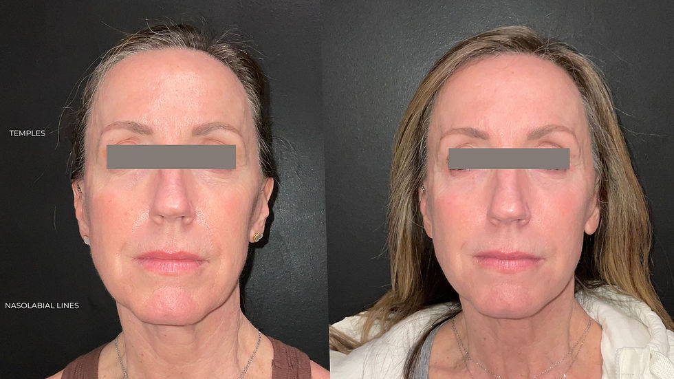 Radiesse_b&a (1).jpg