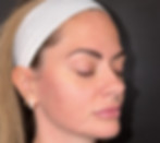 AC_Microneedling_Before_photo.jpg