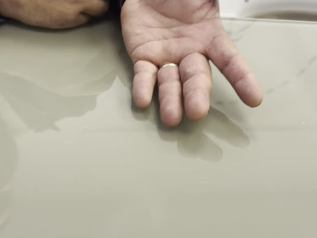 Attention aux blessures de la main pendant les fêtes : conseils et témoignages