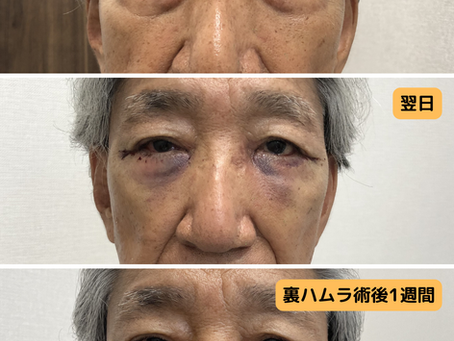 他院切開後の難症例、裏ハムラ法と下眼瞼外眥固定術(LTS)を組み合わせた目の下のたるみ修正