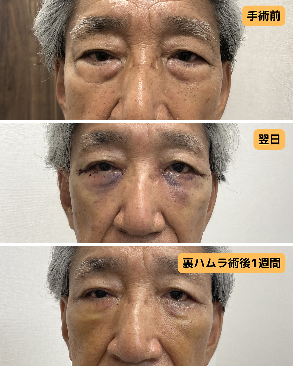他院切開後の難症例、裏ハムラ法と下眼瞼外眥固定術(LTS)を組み合わせた目の下のたるみ修正