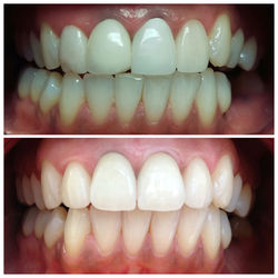 Porcelain Veneers