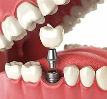 Image depicting an dental implant