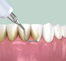 Image showing cleaning of tartar