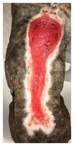 7/5/17 - 6 HBOT Treatments