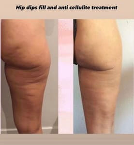 Fat Transfer to Butt before and after