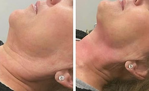 Double Chin Removal before and after
