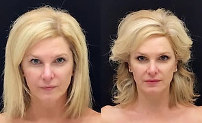 Non Invasive Face Lift before and after
