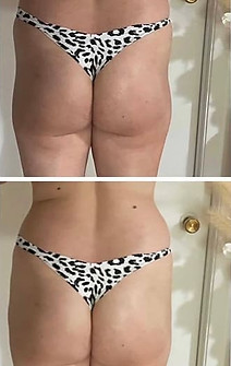 Fat Transfer to The Butt before and after