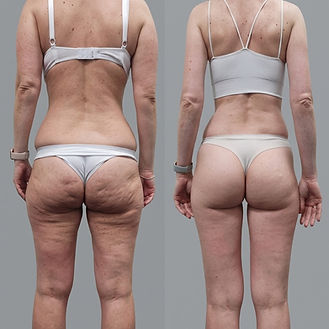 Вакуумно роликовий масаж до після