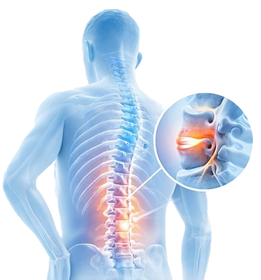 Лікування міжхребцевої грижі у Львові