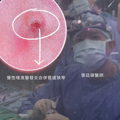 唾液腺內視鏡微創手術