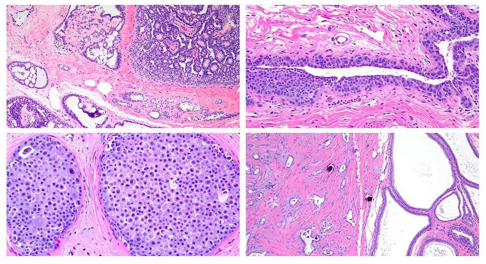80th Annual Seminar: Diagnostic Challenges in Breast Pathology