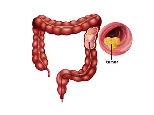 Câncer Colorretal e prevenção