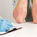gloved-dermatologist-examines-skin-sick-patient-records-observations-examination-diagnosis