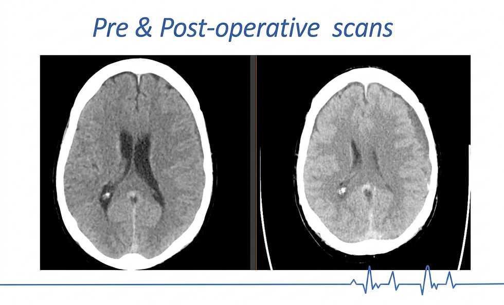 Pre and post-operative brain scans showing complex spinal CSF leak recovery.
