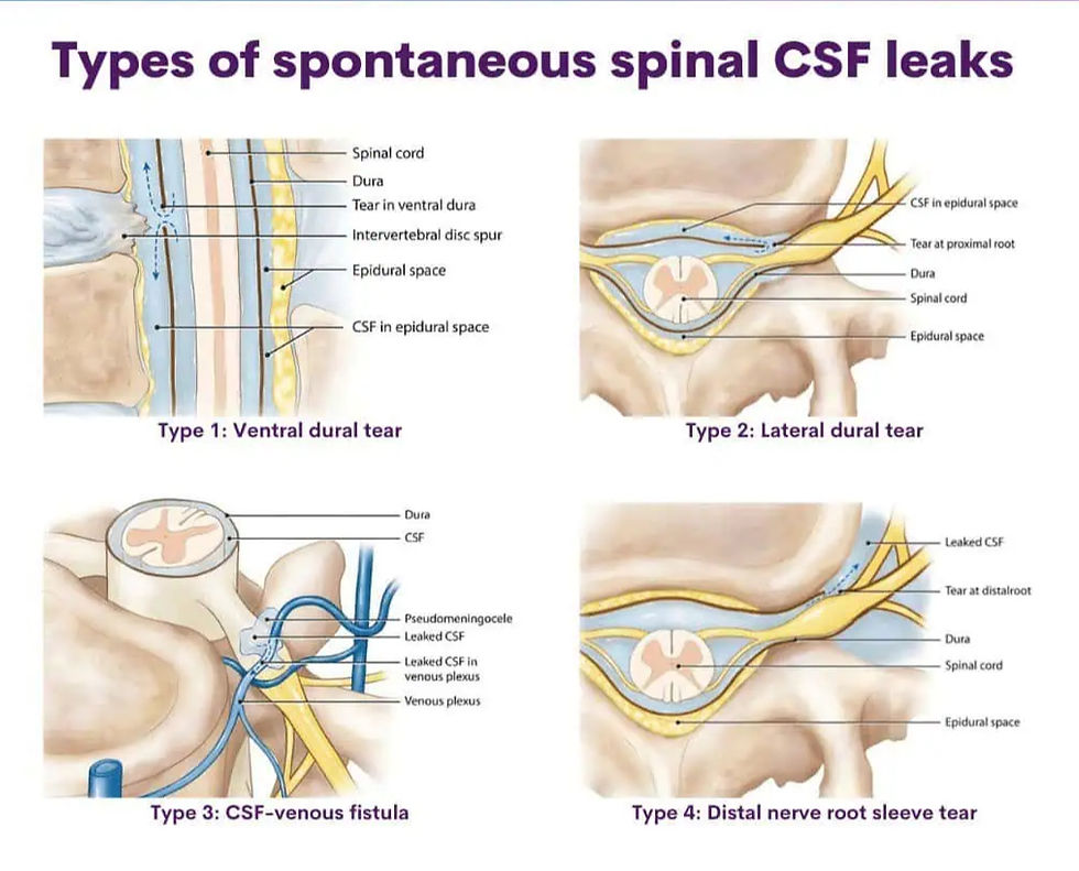 Csf leak types