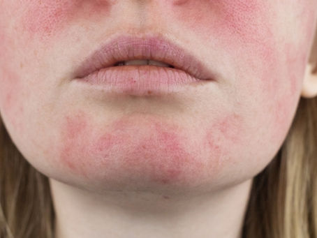 Rosacea Explained