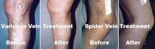 Varicose & Spider Veins - Can lead to blood clots, get checked today.