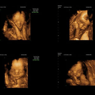 ECOGRAFIA GINECOLOGICA TRANSVAGINALE 3D.jpg