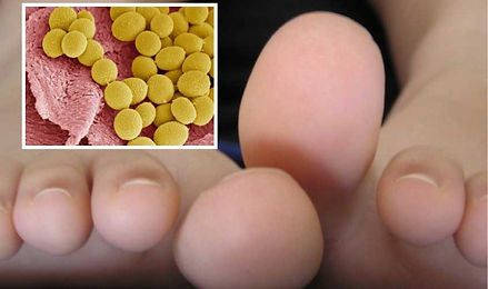 Tinea_Pedis_Main_image-710x434.jpg