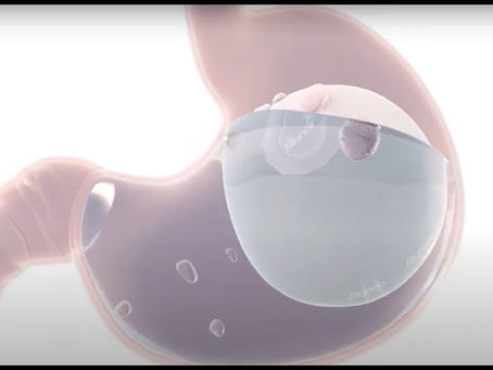 Why Choose the Allurion Balloon? Key Benefits for Your Weight Loss Journey
