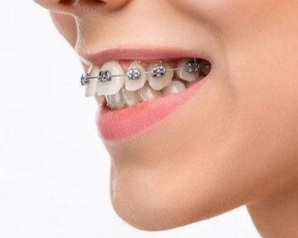 How Dubai Dentists Help Patients Achieve Whiter Teeth After Braces