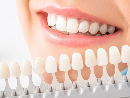Exploring the Results of Composite Veneers in Dubai: Before and After
