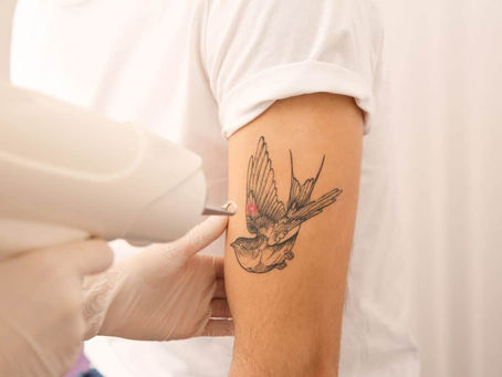 How to Maximize the Effectiveness of Picosure Tattoo Removal in Dubai