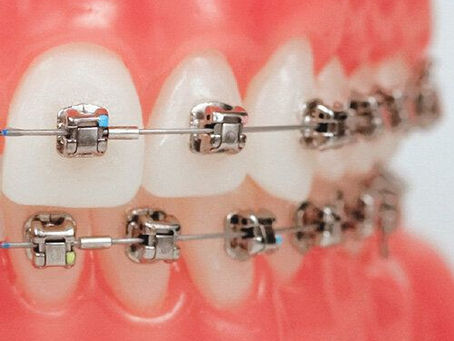 Exploring the Benefits and Drawbacks of Dental Braces in Dubai