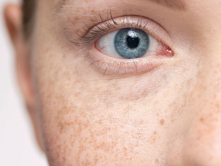 Discover Proven Methods to Eliminate Melasma on Your Skin