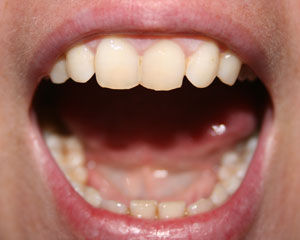 Front teeth slightly open