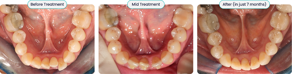 Three-panel lower occlusal dental arch photos labeled Before Treatment, Mid Treatment, and After in just 7 months, showing improved alignment.