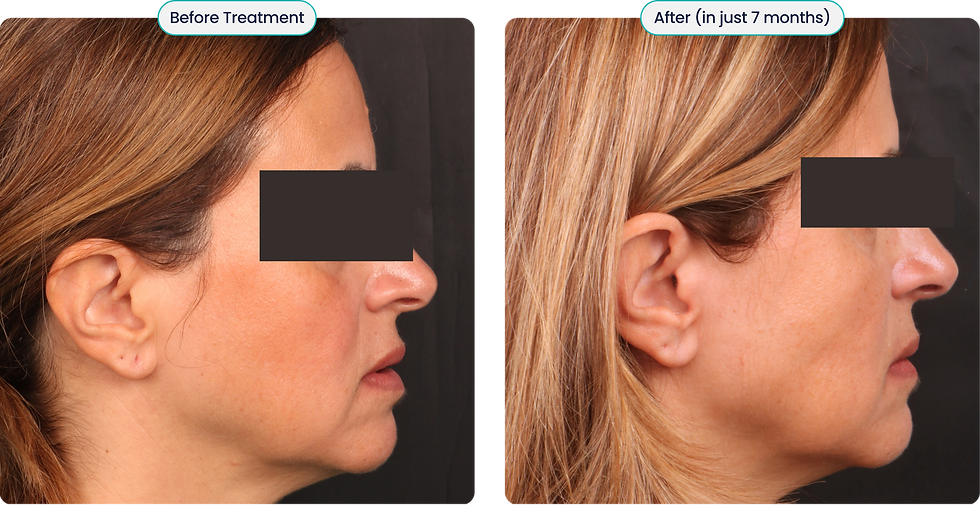 Side-by-side profile of a woman before treatment and after 7 months, showing a straighter profile; labels on dark background.